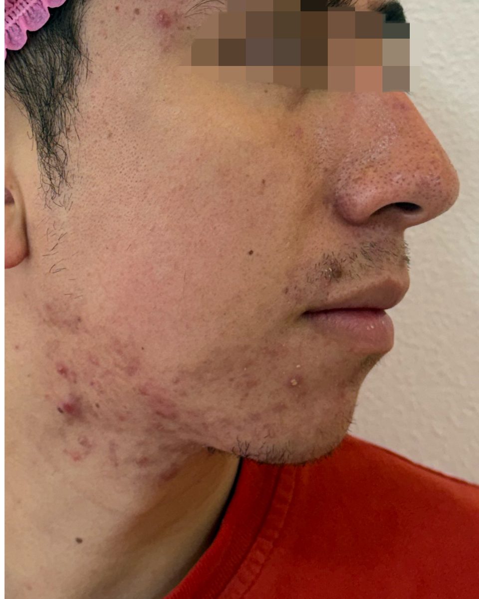 Acné inflamatorio en mejilla y mandíbula, perfil derecho, antes