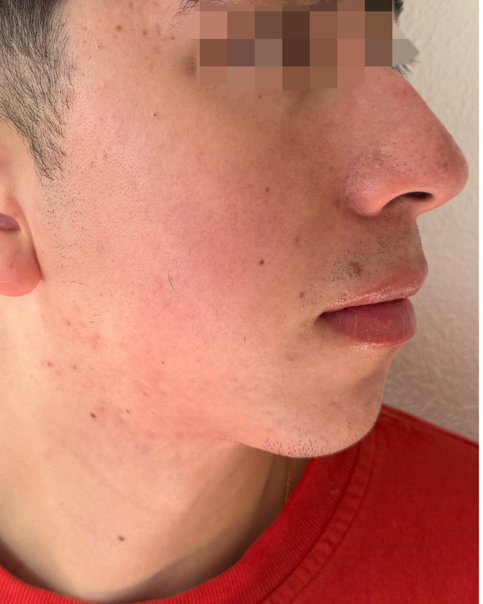 Acné inflamatorio en mejilla y mandíbula, perfil derecho, después
