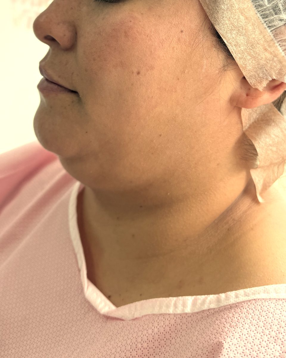 Lipopapada: contorno del cuello y la mandíbula, perfil, antes